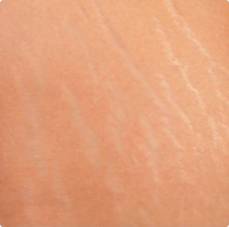 Close-up of skin with visible stretch marks.