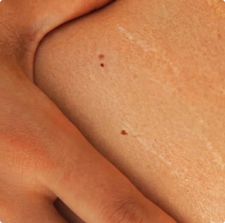 Close-up of a hand on skin with two small moles.