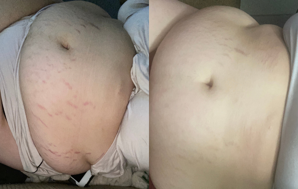 A before-and-after image showing the fading of stretch marks on a person's stomach.