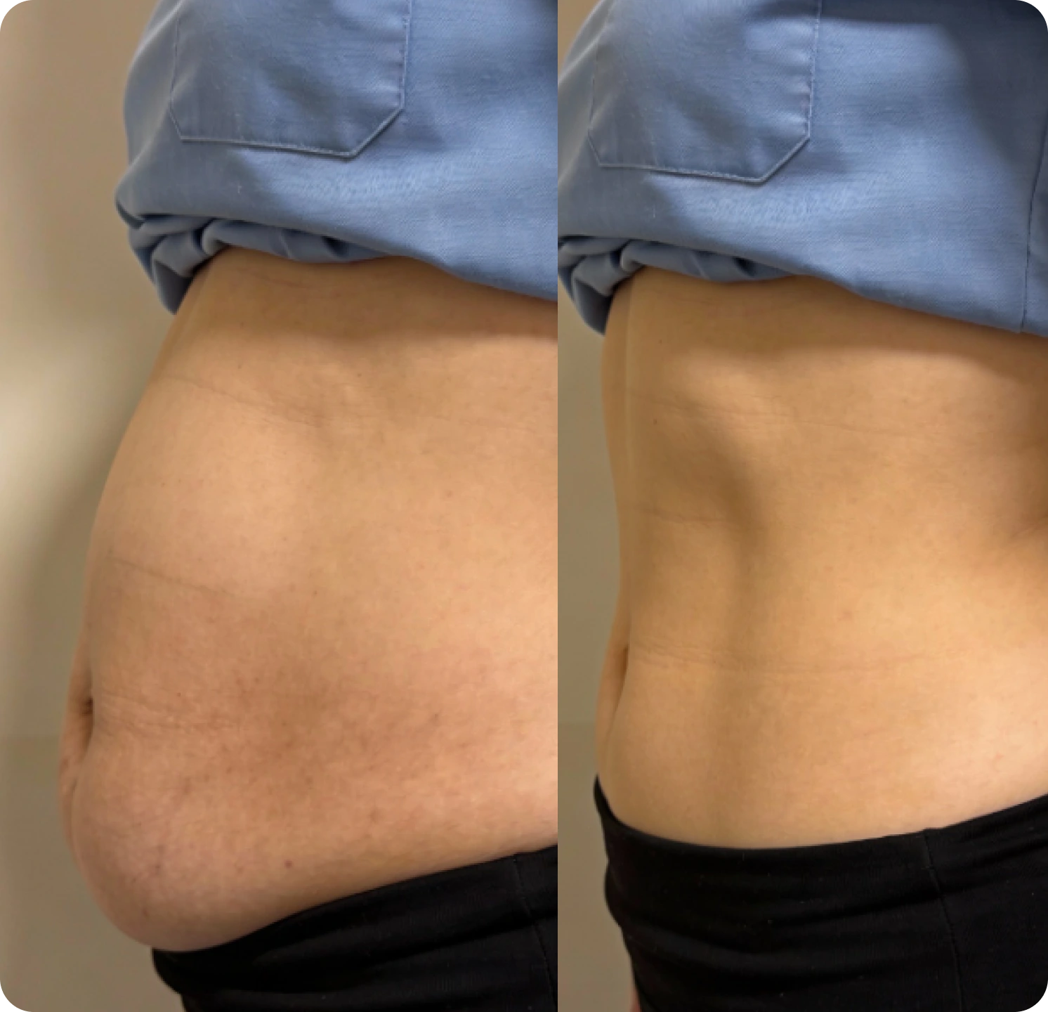 Before-and-after side view images of a person's abdomen, showing a reduction in size and improved tone.
