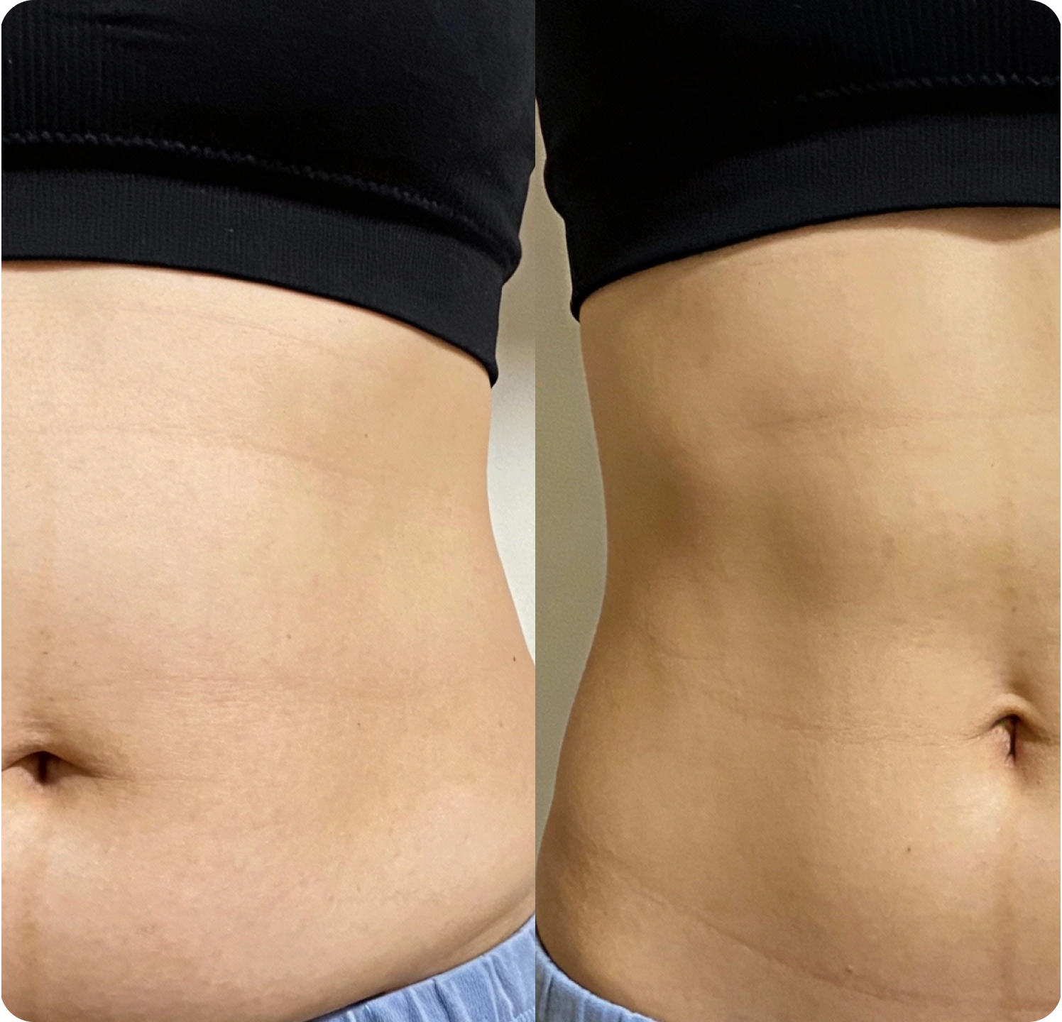 A before and after comparison of a woman's stomach, which appears smoother and more toned on the right.