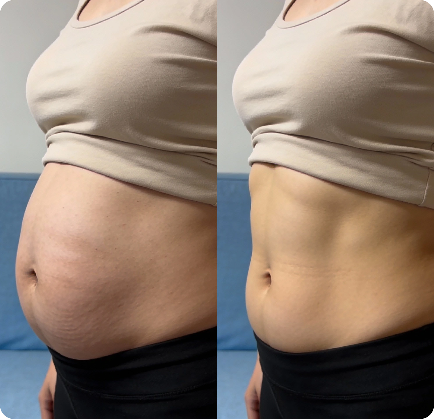 A split image showing a woman's stomach before and after, with the stomach appearing flatter on the right.