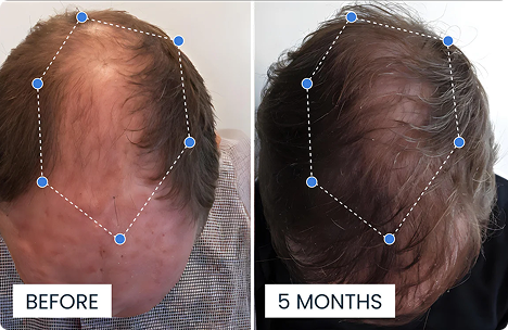 Side-by-side comparison of hair growth over five months, shown from above.