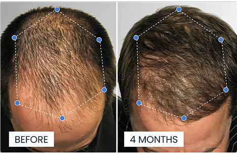 Comparison of hair density on a man's scalp before and after 4 months.