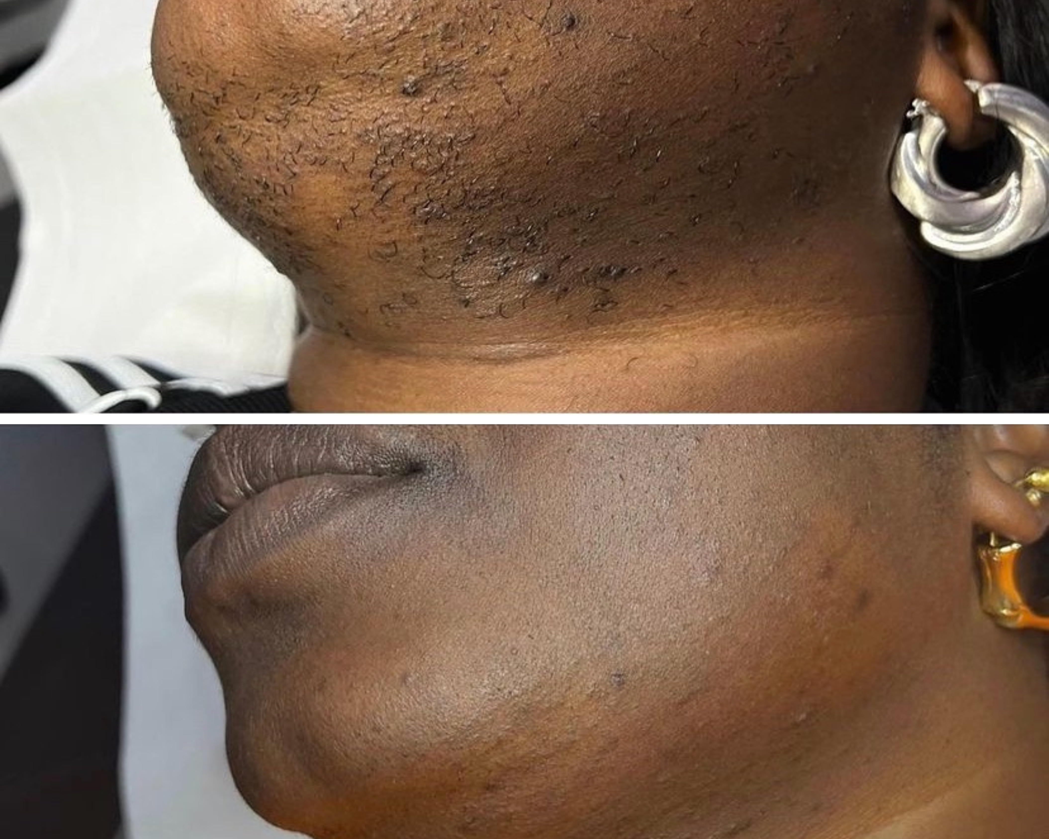 Side-by-side comparison of skin under the chin, showing before and after treatment.