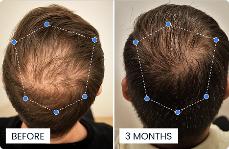 Comparison of hair thickness before and after 3 months, with blue points marking areas on the scalp.