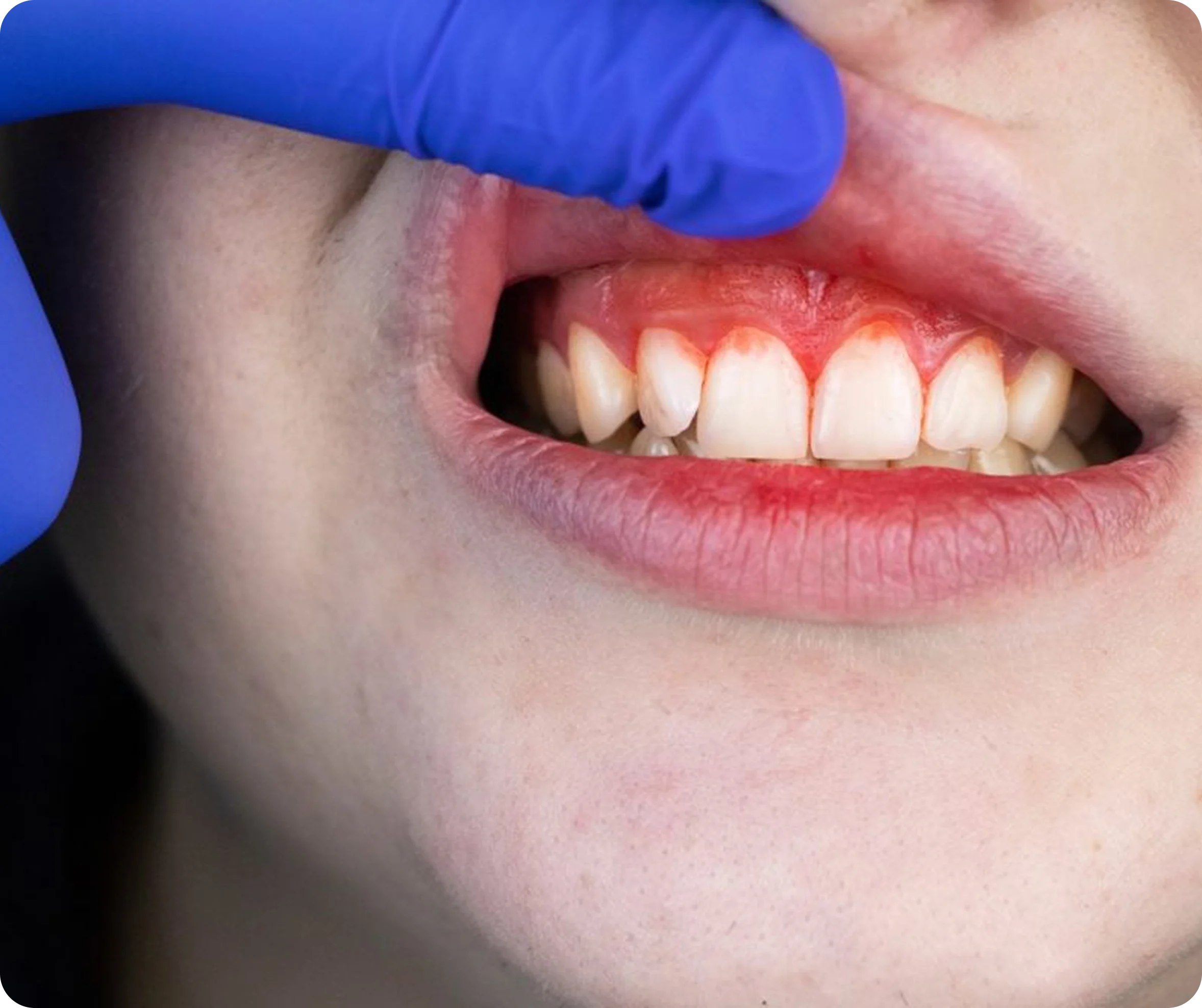 Close-up of a person's teeth and gums being examined with a gloved hand.