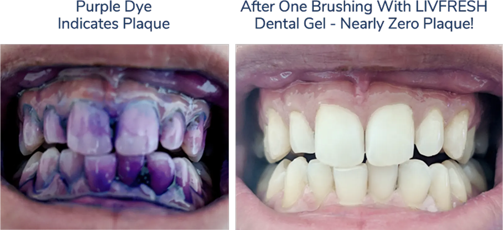 Tube of LivFresh foaming dental gel, wintergreen flavor.