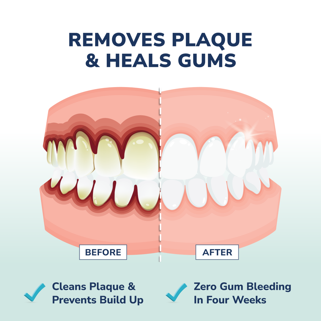 A before and after illustration showing teeth and gums, from plaque-covered and inflamed to clean and healthy.