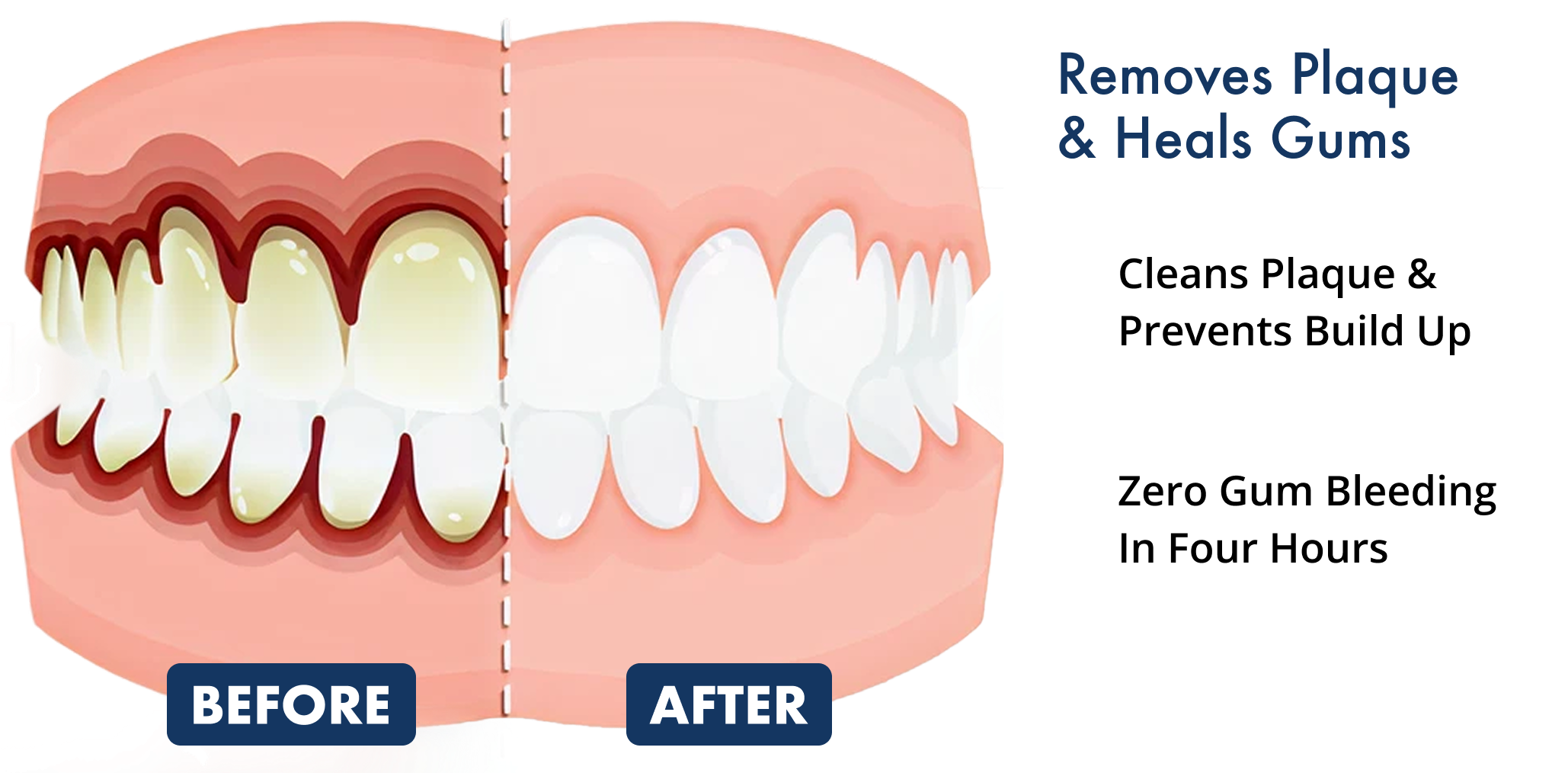 Illustration of teeth before and after plaque removal, with text about gum health benefits.