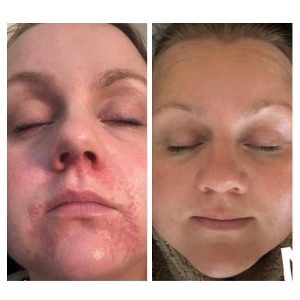 Close-up of a woman's face showing skin condition before and after treatment.