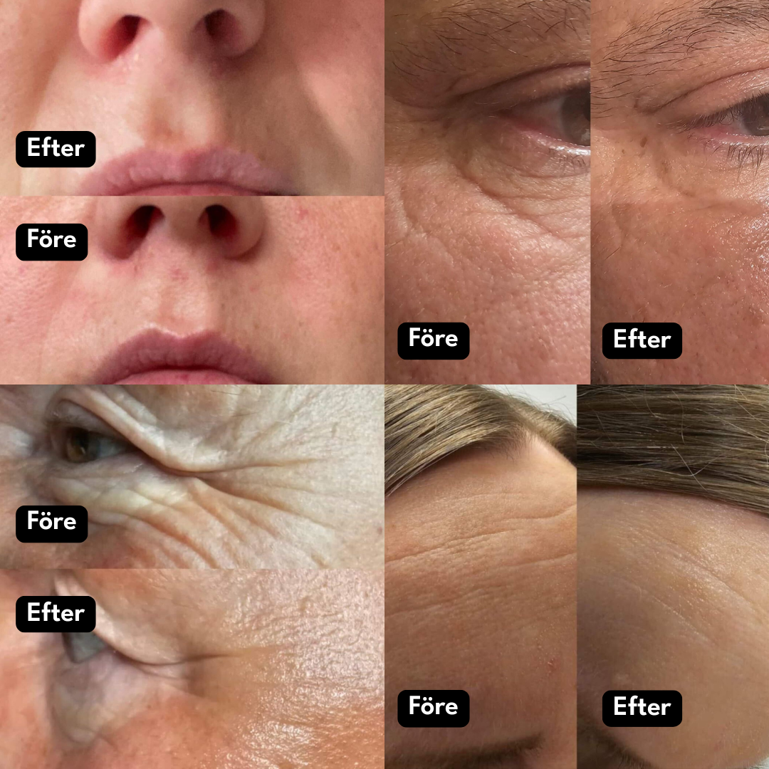 Collage of before and after close-ups of facial skin.