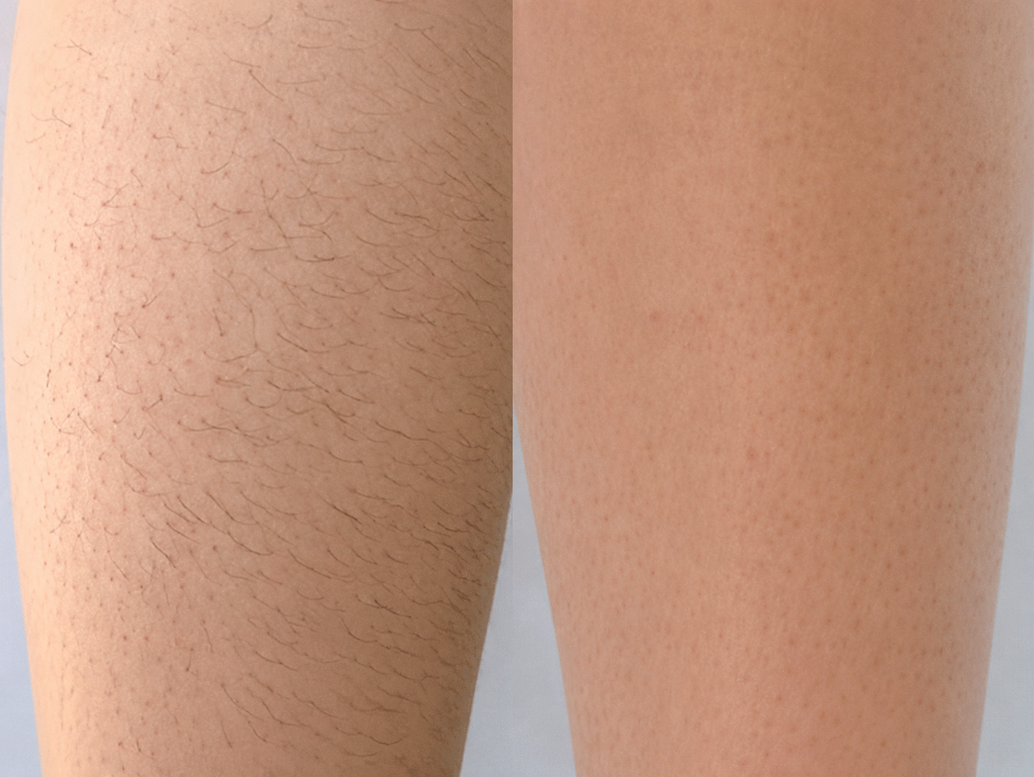 A side-by-side comparison of a leg before and after hair removal, showing hairy and smooth skin.