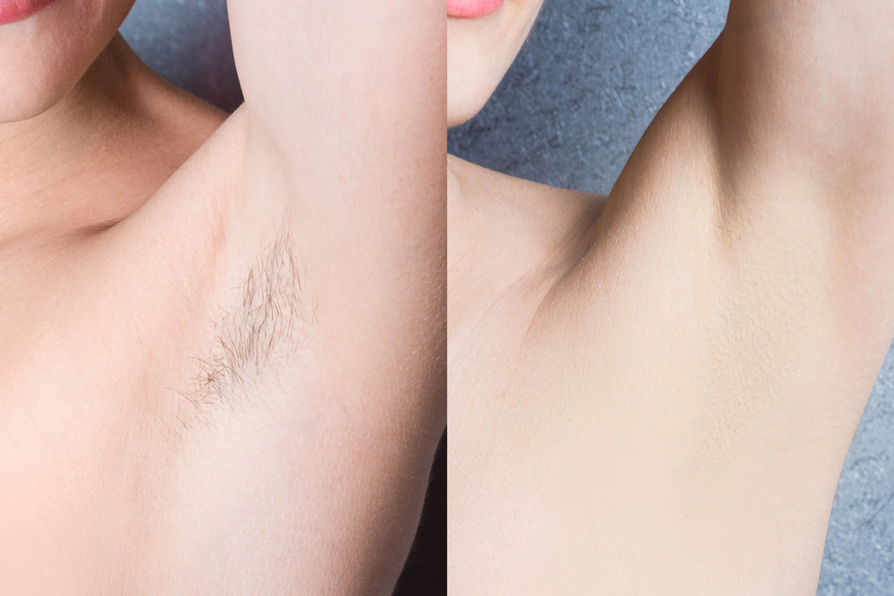 A split-screen comparison showing an underarm before and after hair removal.