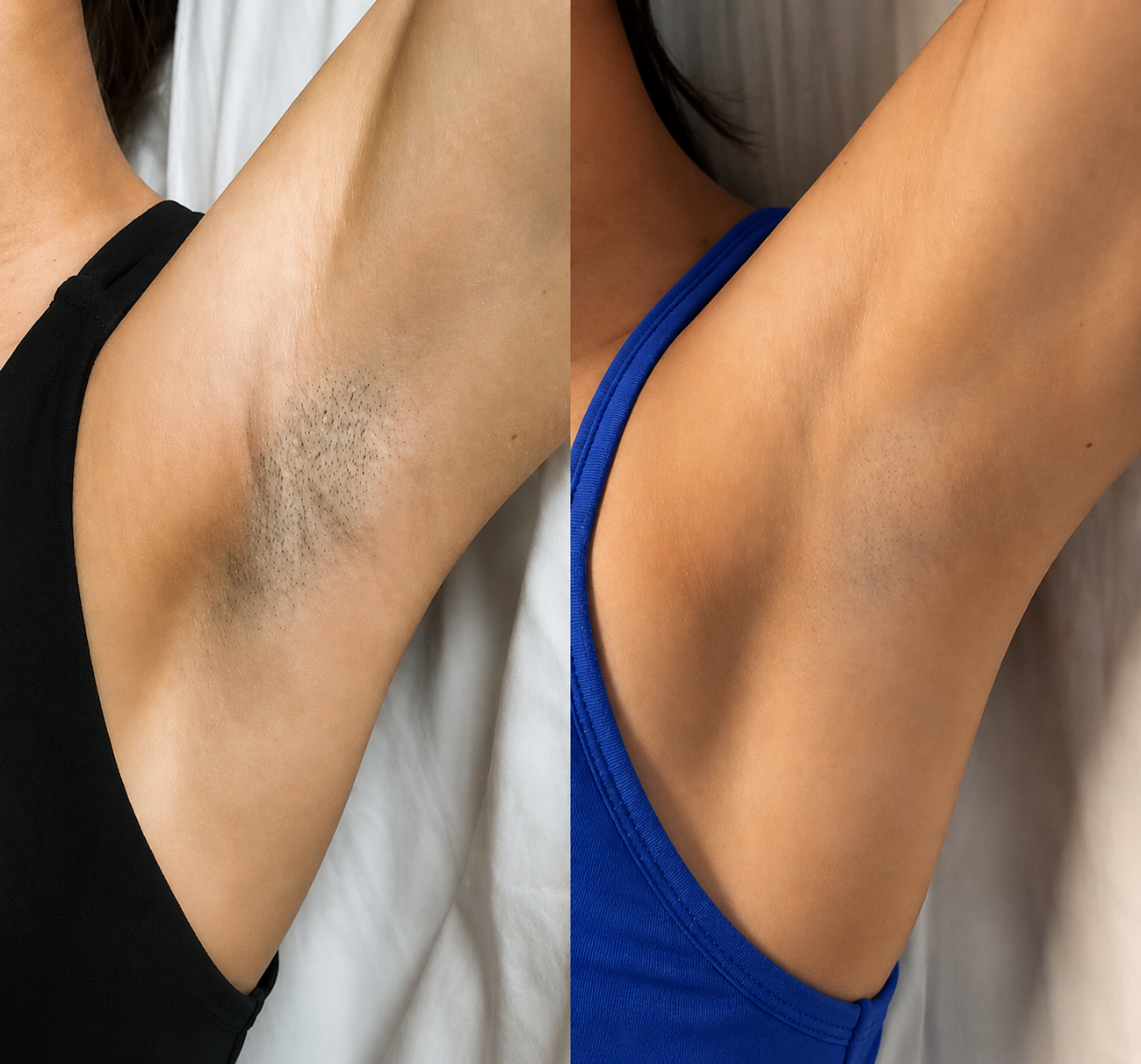 A before and after comparison of a woman's underarm, showing the results of hair removal.