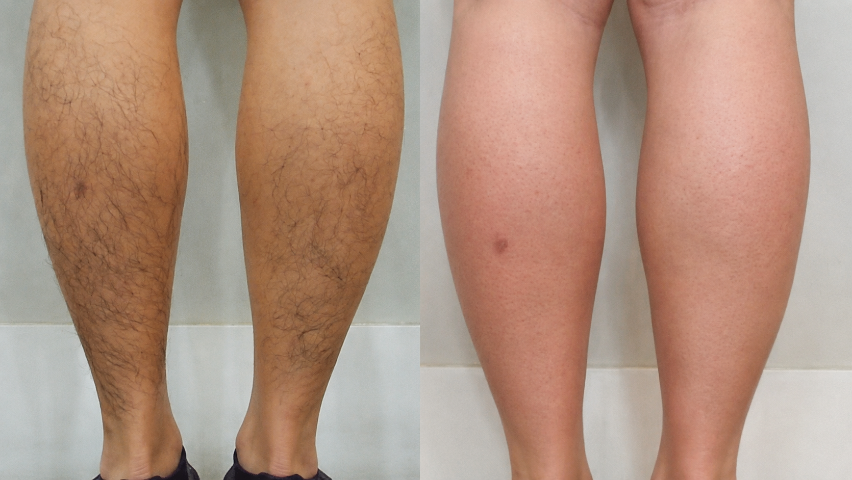 A side-by-side comparison of a person's lower legs before and after hair removal.
