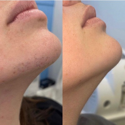A before-and-after image showing the removal of hair stubble from a person's chin and neck area.