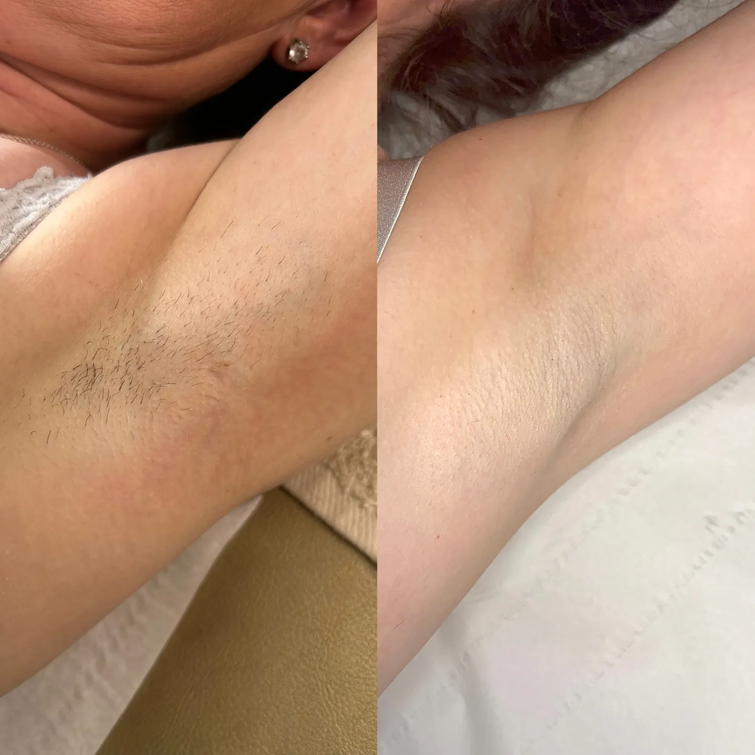 A before-and-after image showing an armpit with hair on the left and smooth without hair on the right.