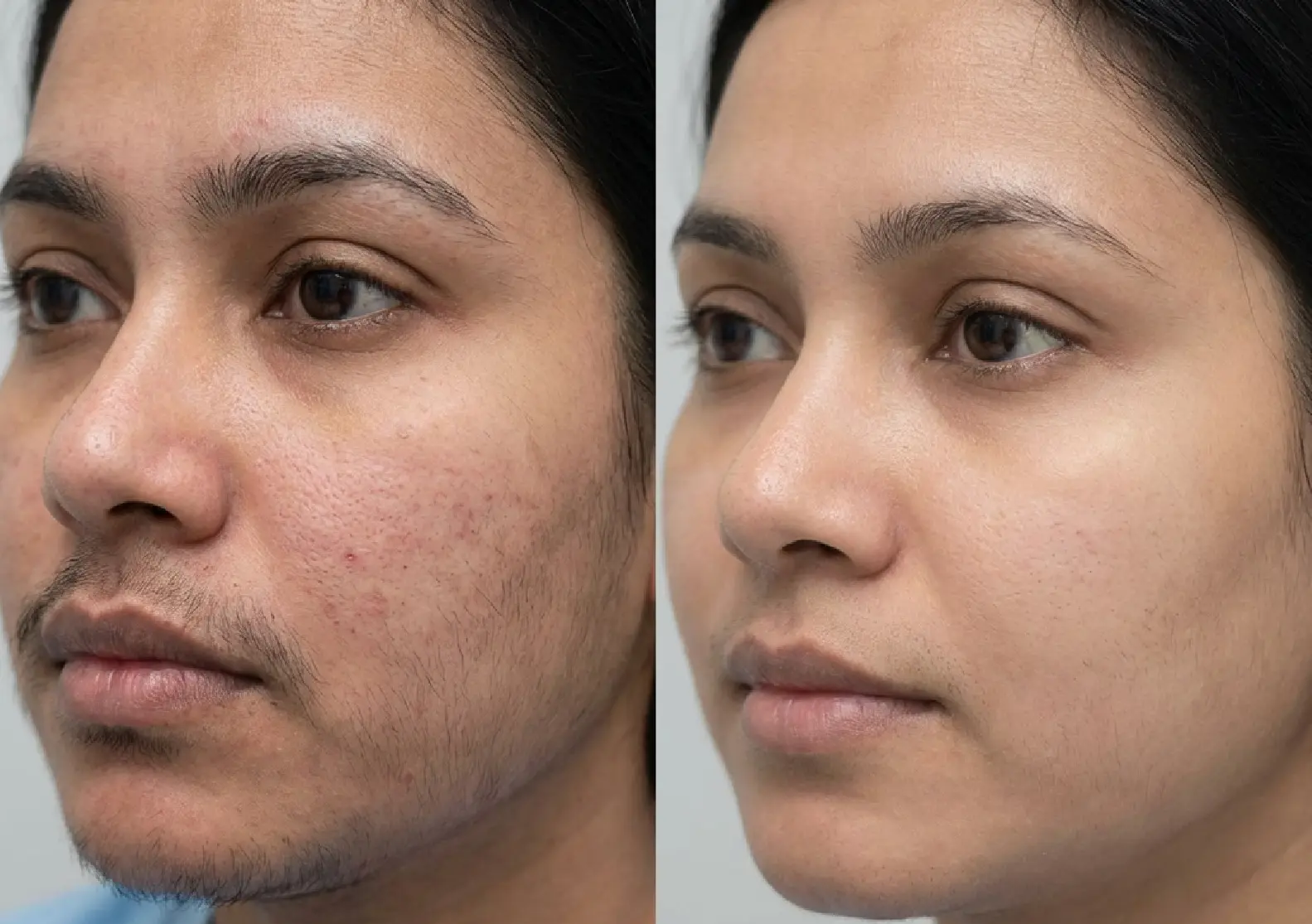 A before-and-after comparison of a person's face, showing clearer skin and reduced facial hair on the right.