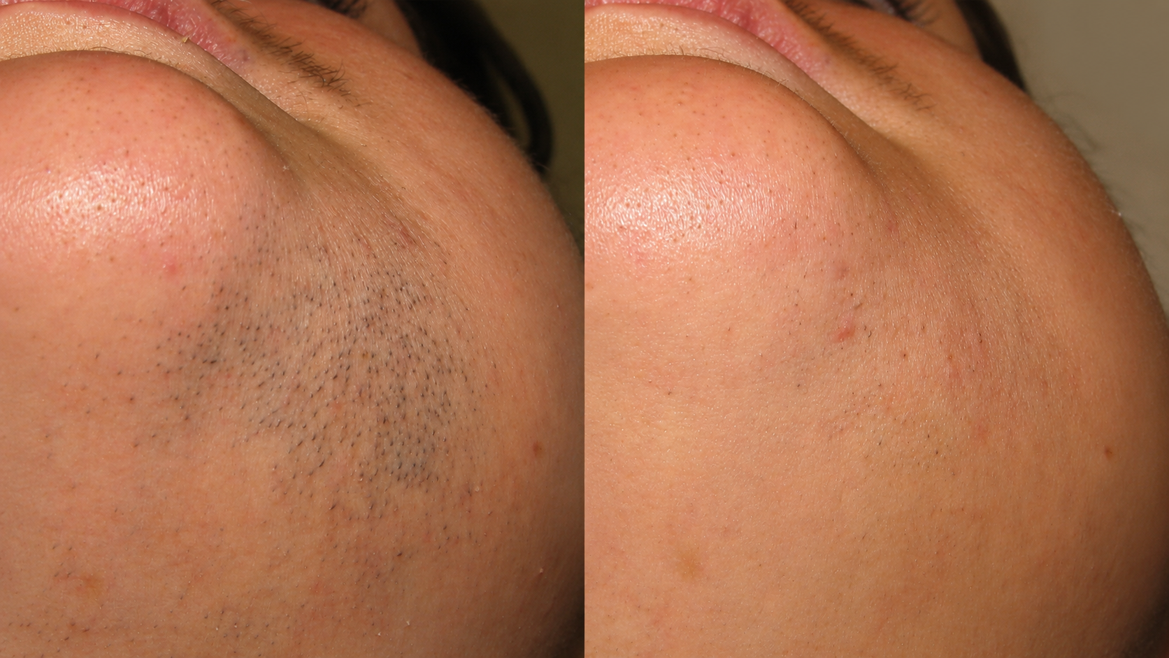 A before and after close-up of a person's chin showing the results of hair removal.