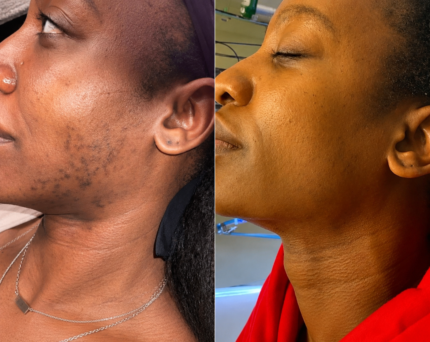 A before and after image of a woman's face, showing a reduction in dark spots and hair.