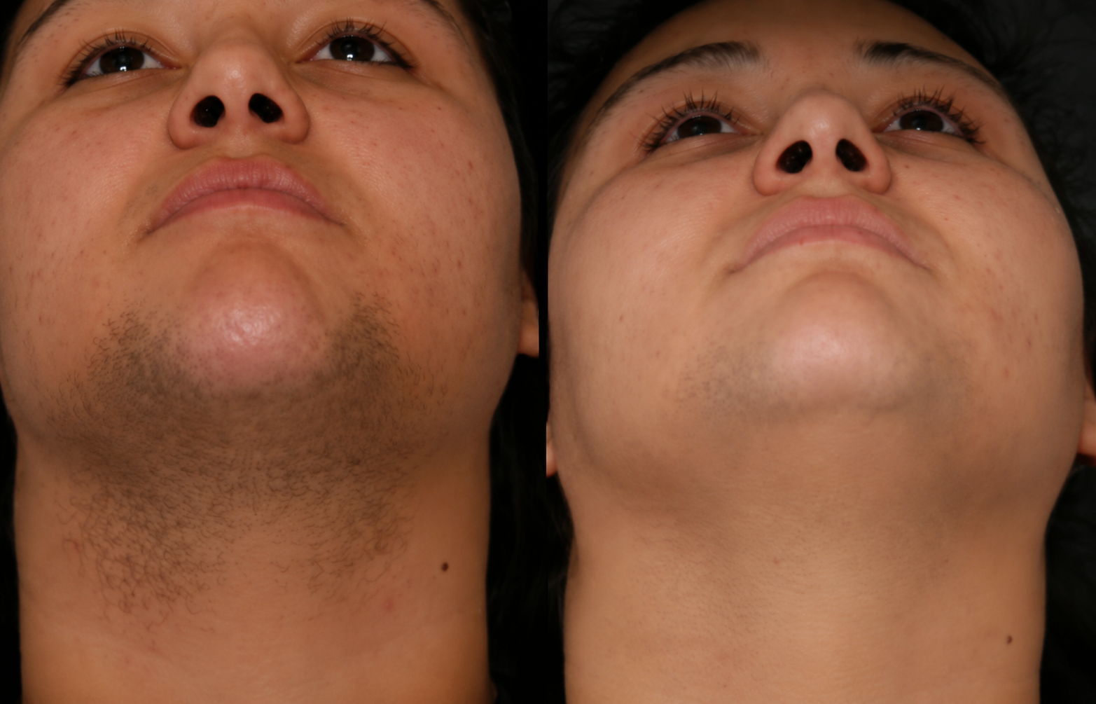 Before and after photos showing a reduction of facial hair on a person's chin and neck.