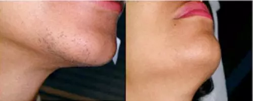 A before-and-after image showing the results of hair removal on a person's chin and neck.
