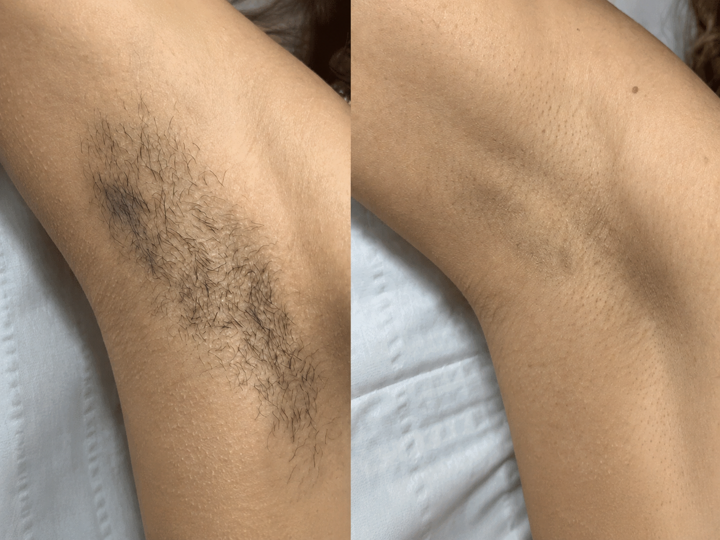 A side-by-side image showing an armpit before and after hair removal.