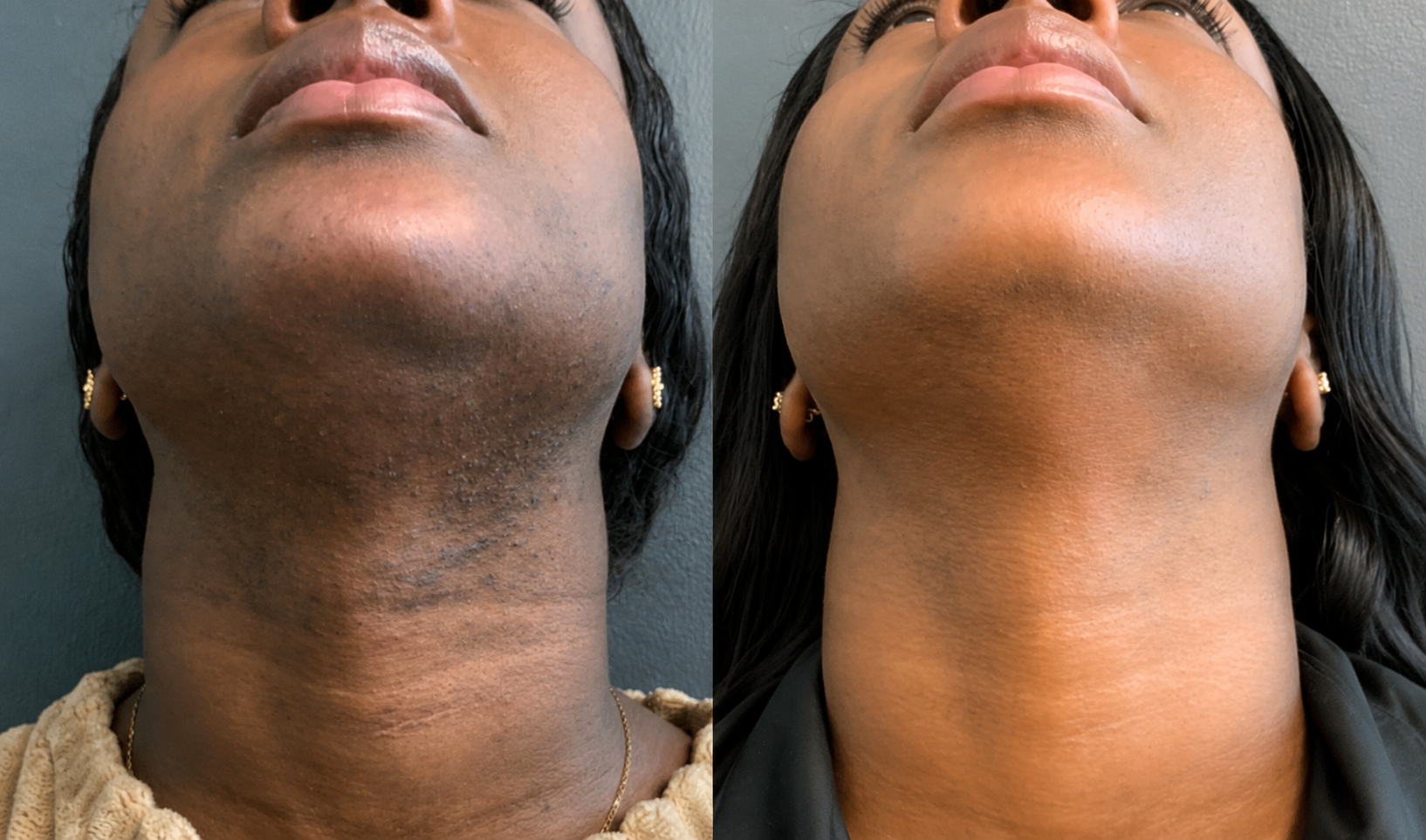 A side-by-side comparison of a woman's chin and neck, before and after a hair removal treatment.