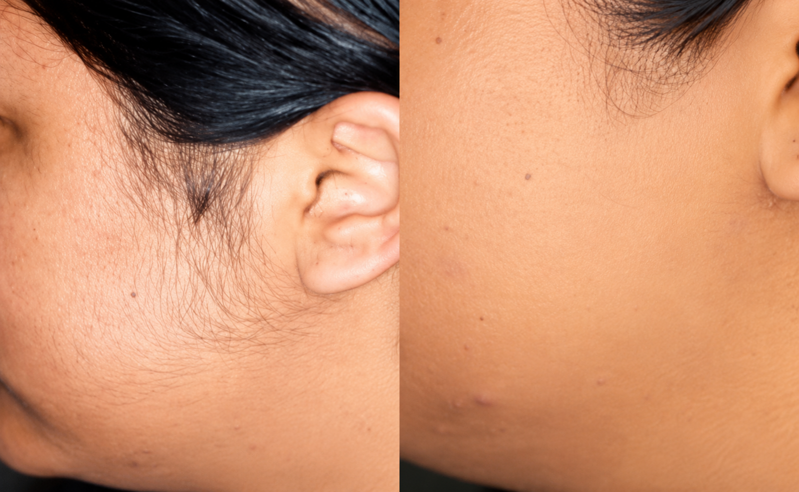 A before-and-after image showing hair removal on the side of a person's face.