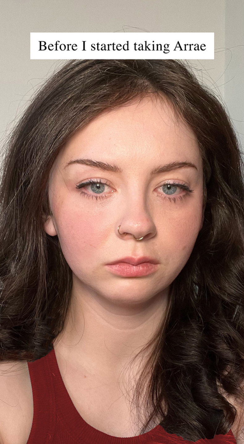 Woman with dark hair and nose ring, text above reads 'Before I started taking Arrae.'