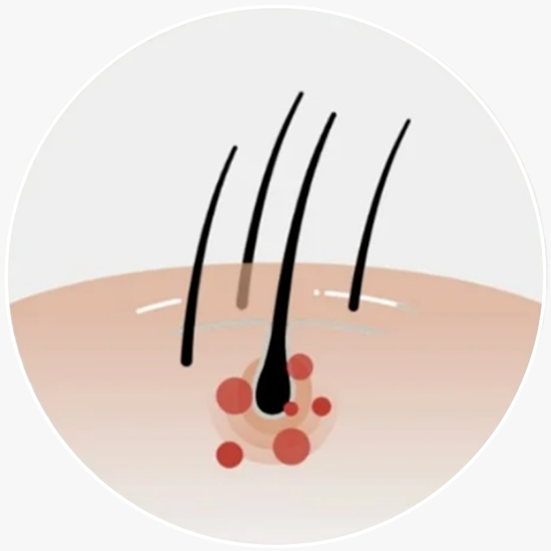 Illustration of hair strands emerging from skin with red spots.