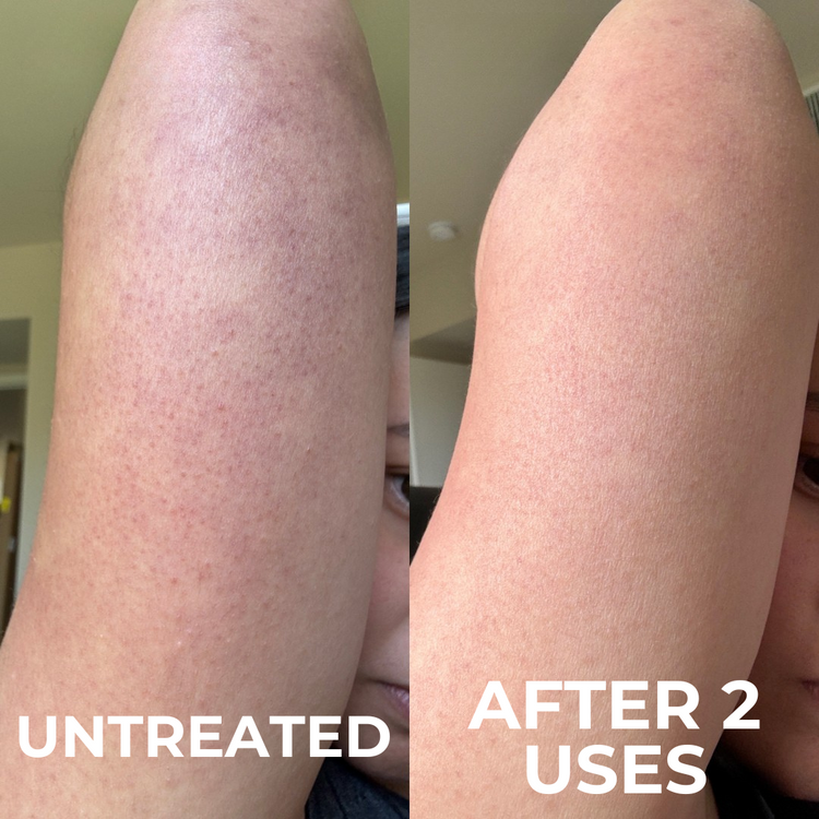 A before-and-after image showing an arm with bumpy, red skin becoming smoother and less red after treatment.