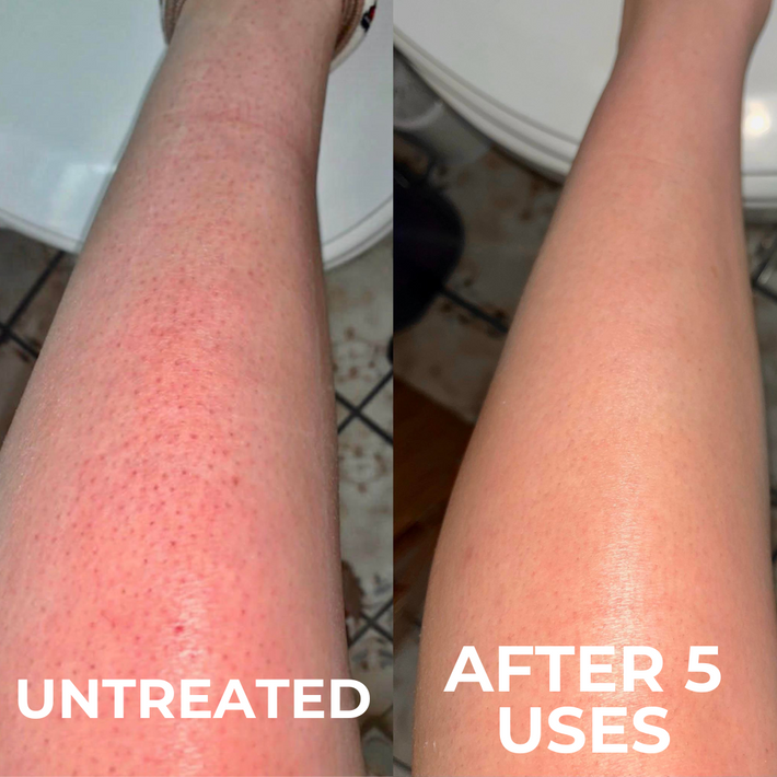 A before-and-after comparison of a leg, labeled 'Untreated' and 'After 5 Uses,' showing reduced redness and smoother skin.