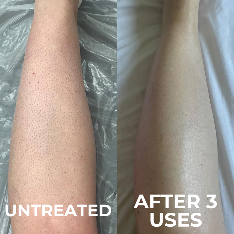 A before-and-after image showing a leg with bumpy skin on the left and smoother skin on the right.