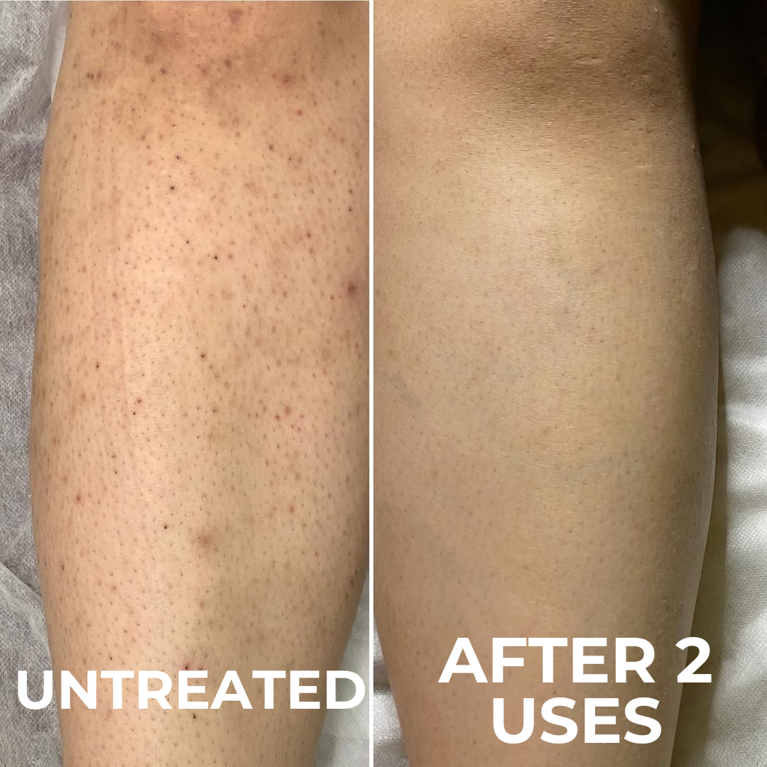 A before-and-after image of a leg, showing a reduction in the appearance of dark pores after two uses.