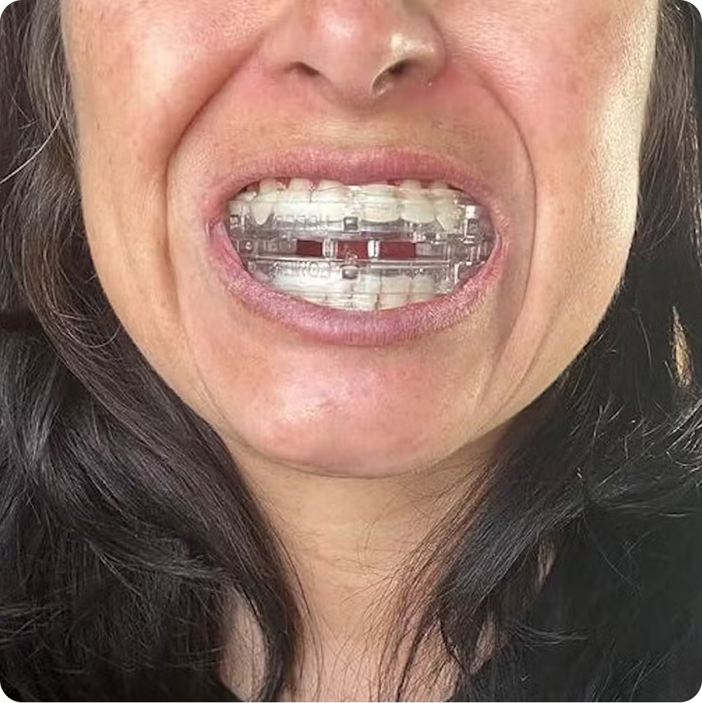 Close-up of a person showing a mouthguard on their upper teeth.