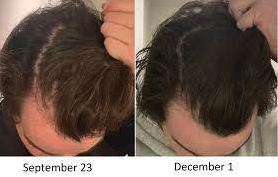 Comparison of hair growth on two dates: September 23 and December 1.