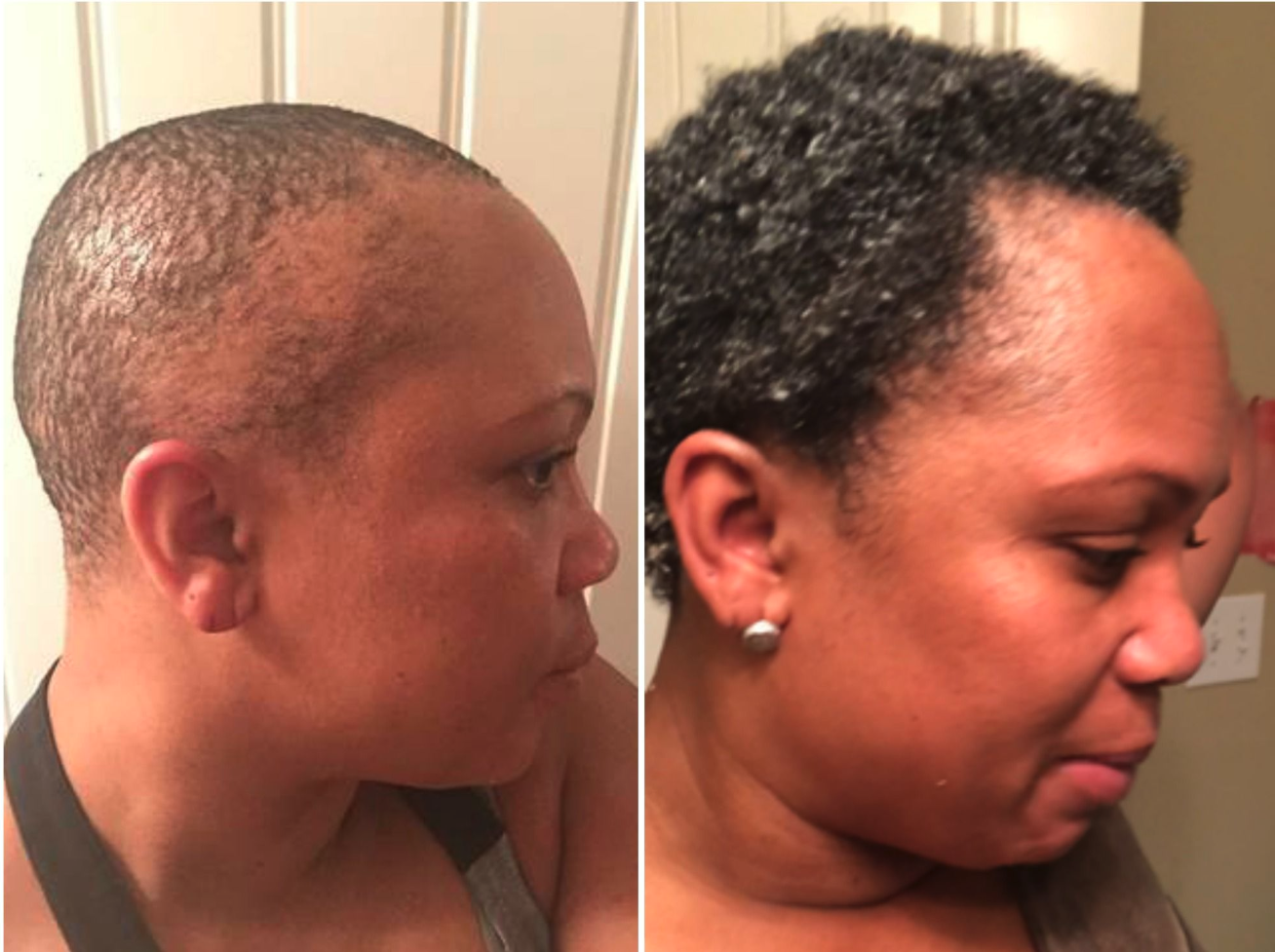 Side-by-side comparison of hair growth, before and after.