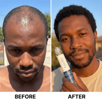 Before and after hair growth comparison