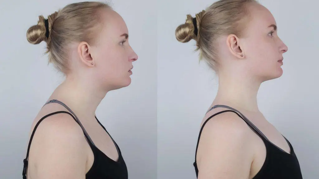 Side-by-side profile comparison of a woman with different neck postures.