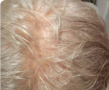 A close-up of the top of a person's head, showing a scalp with thinning white hair.