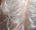 A close-up view of a person's scalp with thin, white and gray hair parted in the middle.