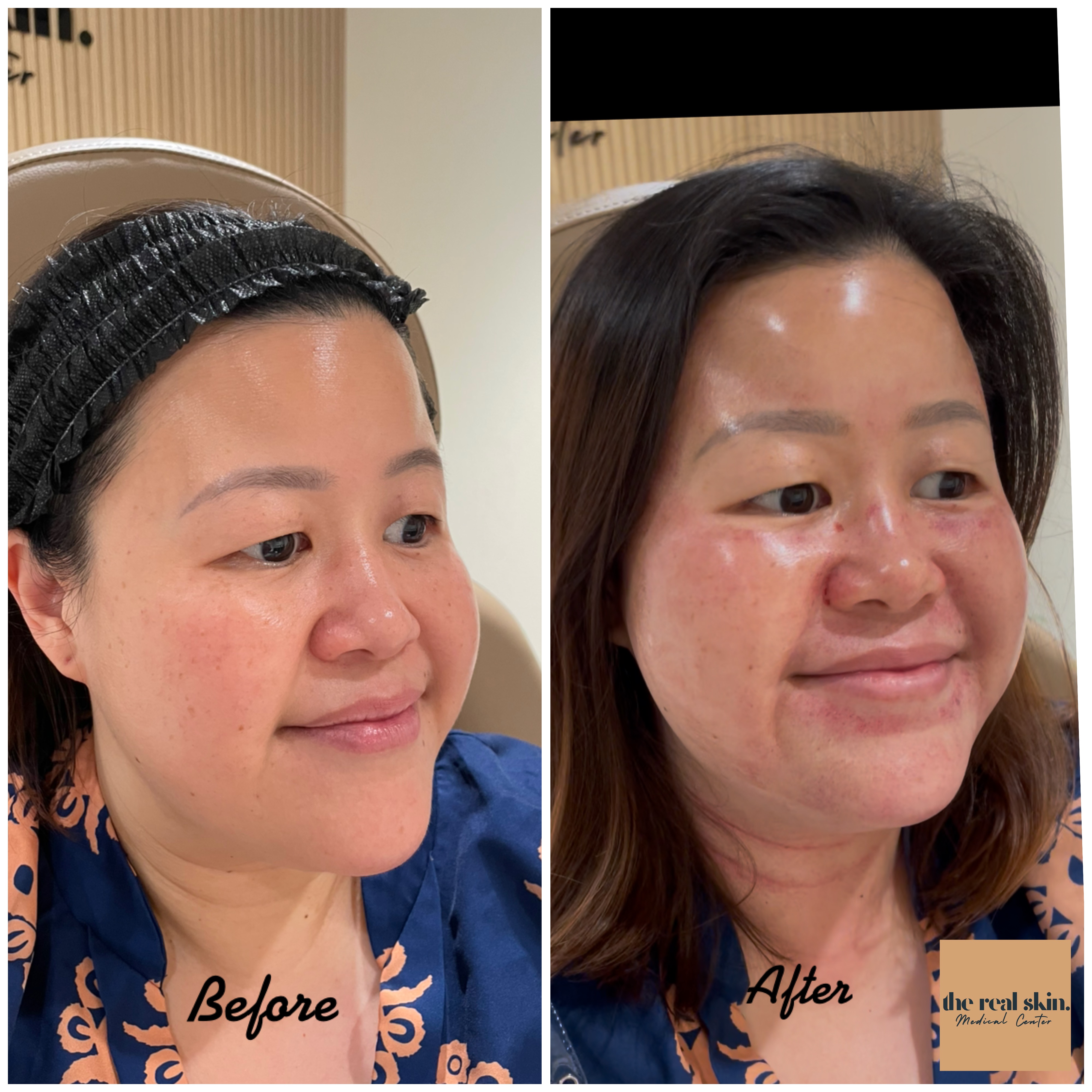 Side-by-side comparison of a woman's face before and after treatment.