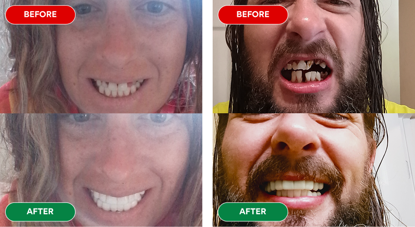 Before and after dental transformation of two individuals showing improved teeth.