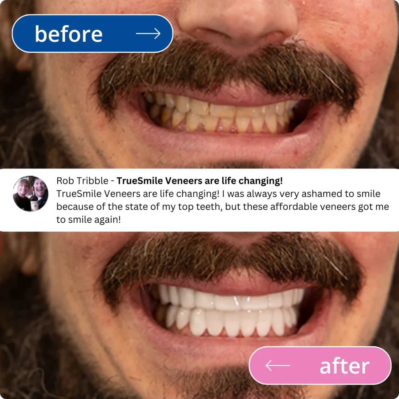 Before and after images of a person's smile with veneers.