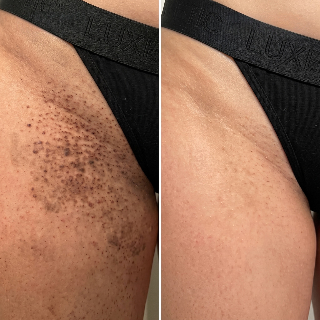 A before and after image of a bikini line, showing the reduction of dark hair stubble.