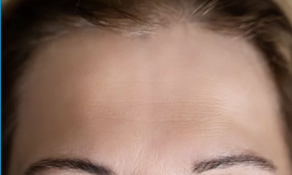 A close-up of a person's forehead showing wrinkles and fine lines, with the top of their eyebrows visible.