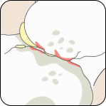 Illustration of a herniated disc compressing a nerve in the spine.