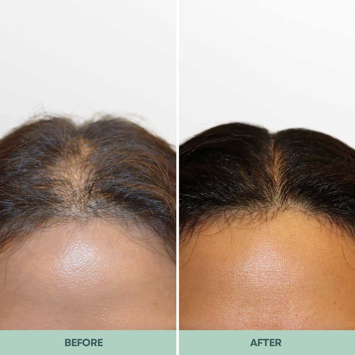 A before-and-after image showing a woman's scalp, with thinning hair on the left and fuller hair on the right.